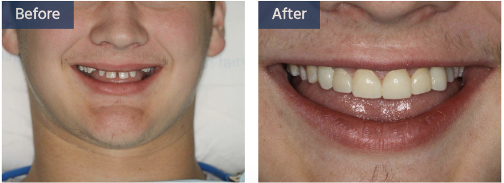 patient's smile before and after crowns