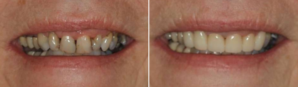 patient's smile before and after dental crowns