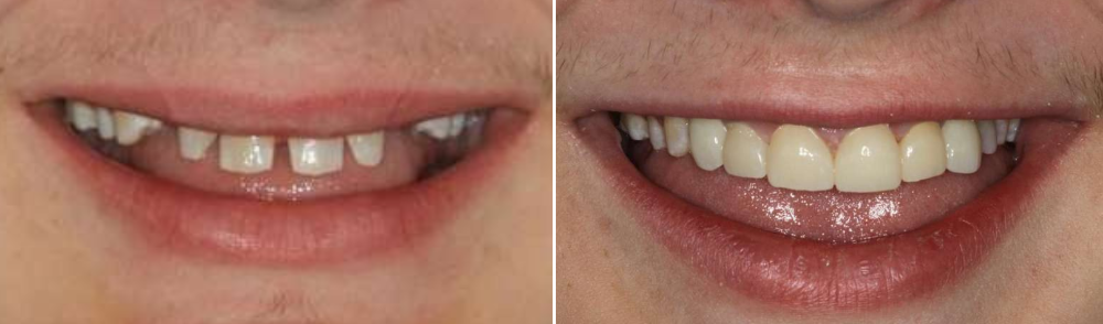 before and after smile 