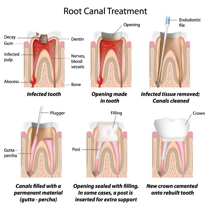 root canal treatment diagram