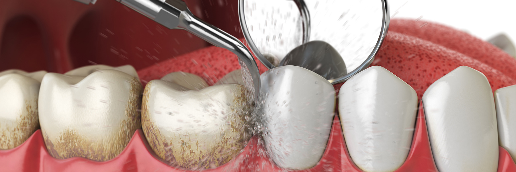 3D illustration of dental cleaning removing plaque and tartar from lower teeth