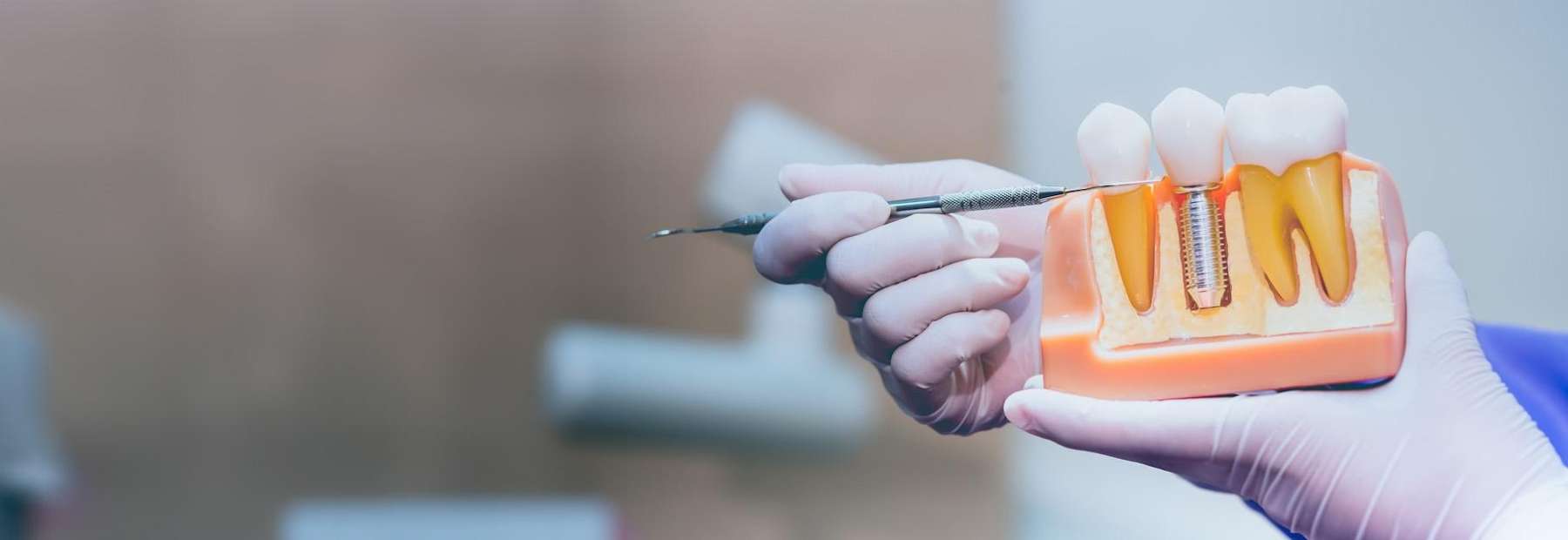 dental implants kalamazoo, MI