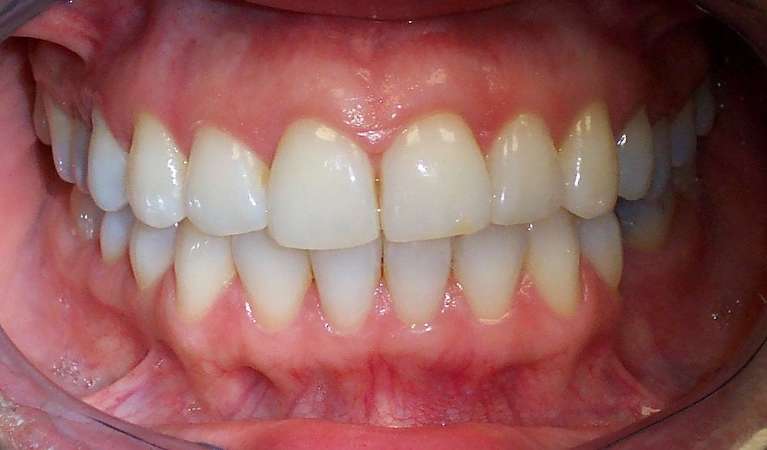 Clear-Aligners-After-Image