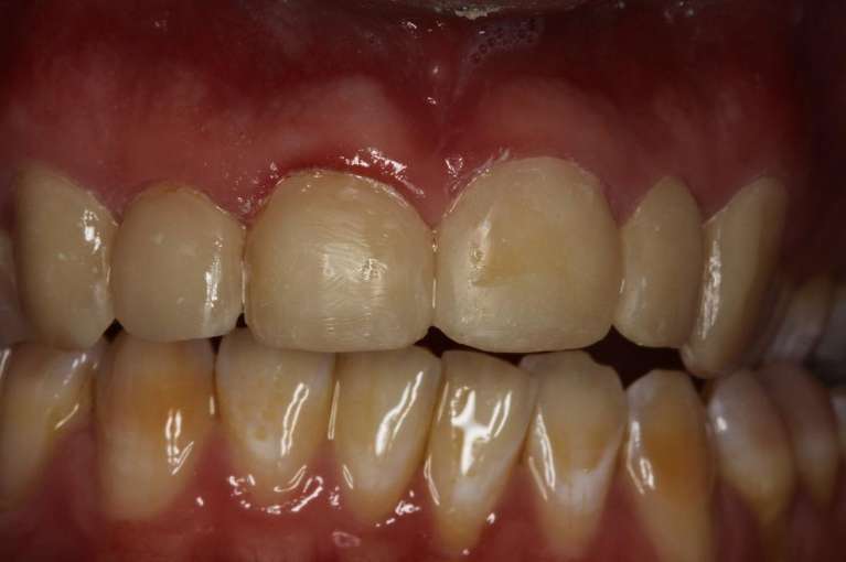 Composite-Veneers-After-Image