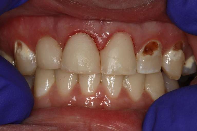 Composite-Dental-Fillings-Upper-Front-Teeth-After-Image