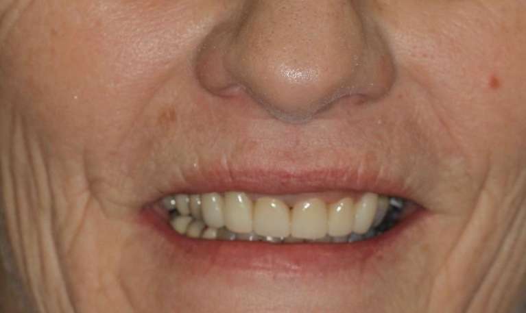 crowns to repair gaps between teeth