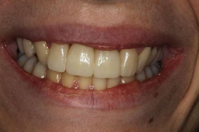 new dental implants