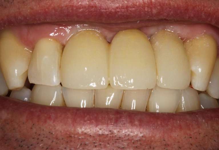Implant-Bridge-Upper-Front-Teeth-After-Image