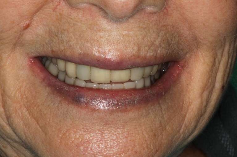 close up of patient's smile after implants