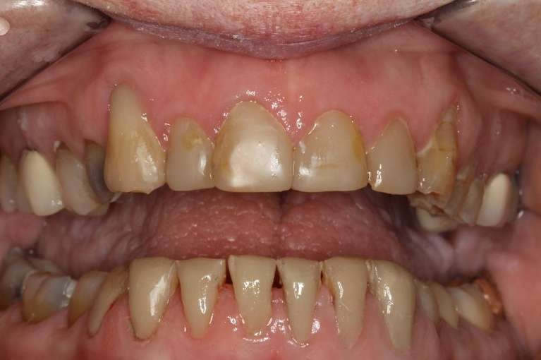 Composite-Dental-Fillings-Lower-Front-Teeth-After-Image