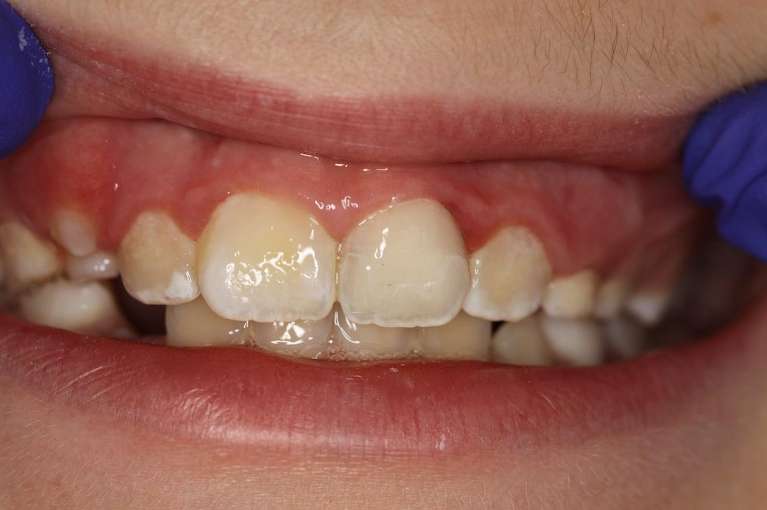 Front-Tooth-Dental-Trauma-After-Image