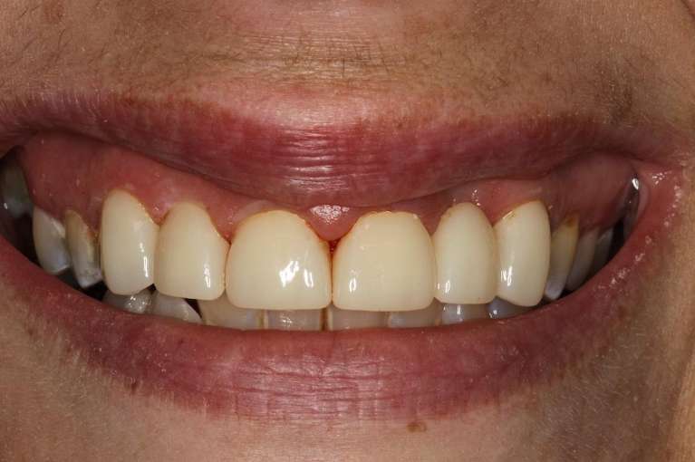 dental bridge for gapped teeth