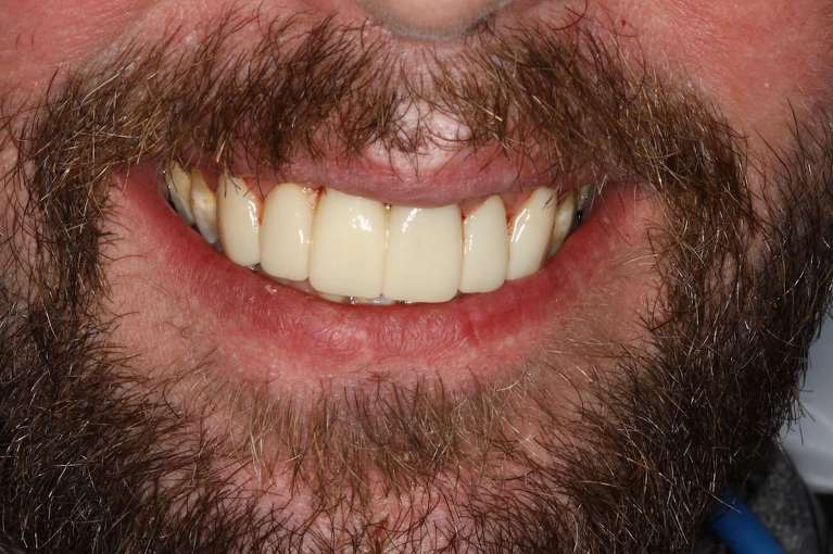 dental crowns for a more uniform smile