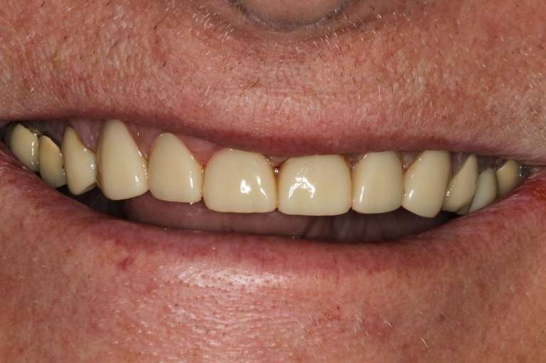 dental crowns used to make a uniform smile