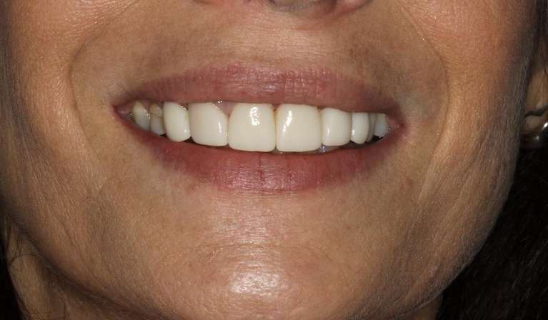 custom dental crowns to correct cracked tooth