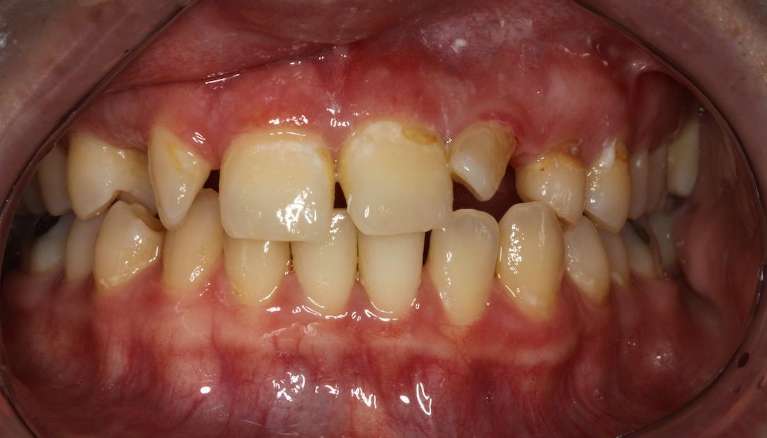 misshapen teeth