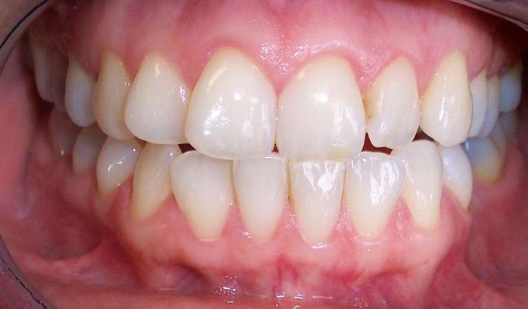 Clear-Aligners-Before-Image