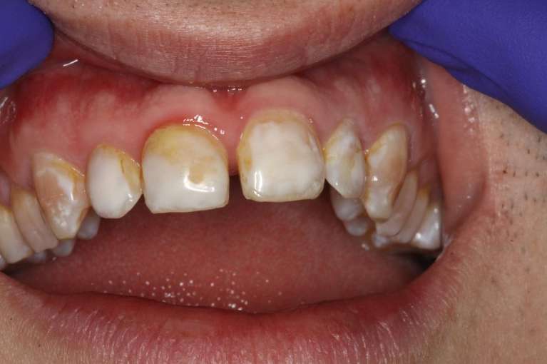 Composite-Veneers-Before-Image