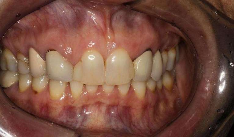 cracked front tooth