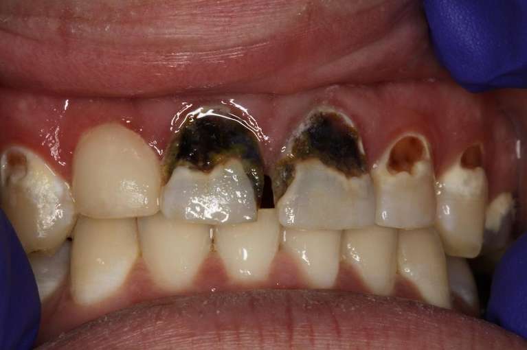 Composite-Dental-Fillings-Upper-Front-Teeth-Before-Image