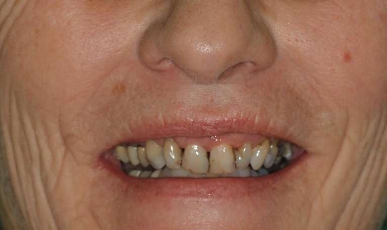 smile with gaps between teeth