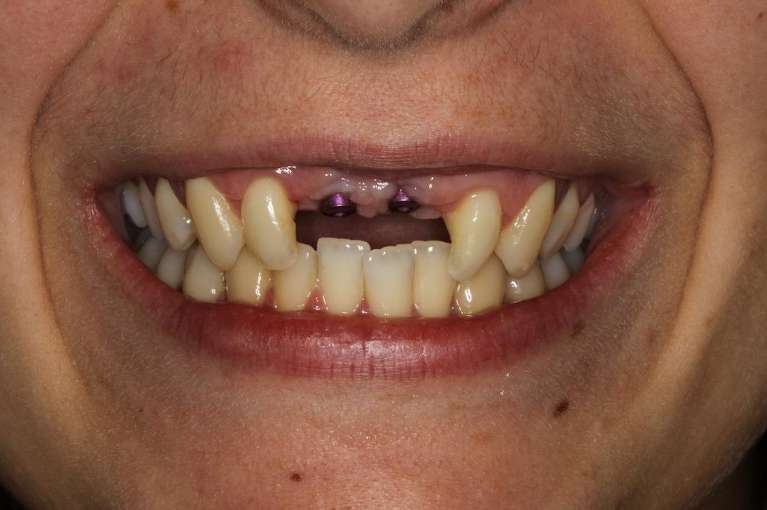 old dental implants