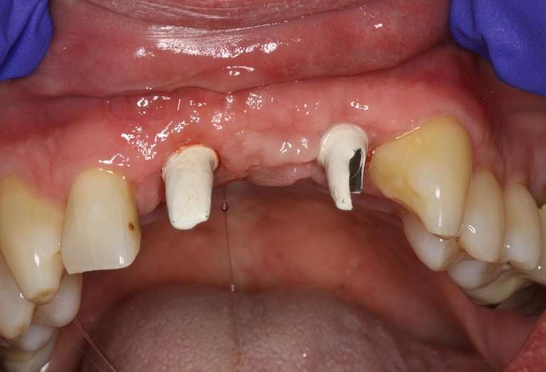 Implant-Bridge-Upper-Front-Teeth-Before-Image
