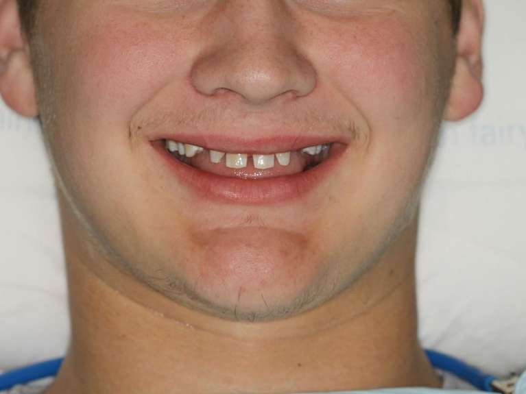 Implants-and-Crowns-Before-Image