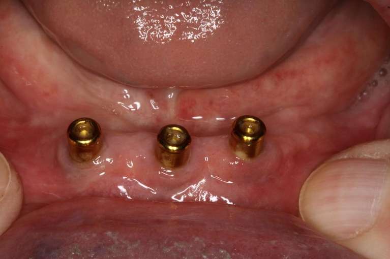 implants in patient's gum