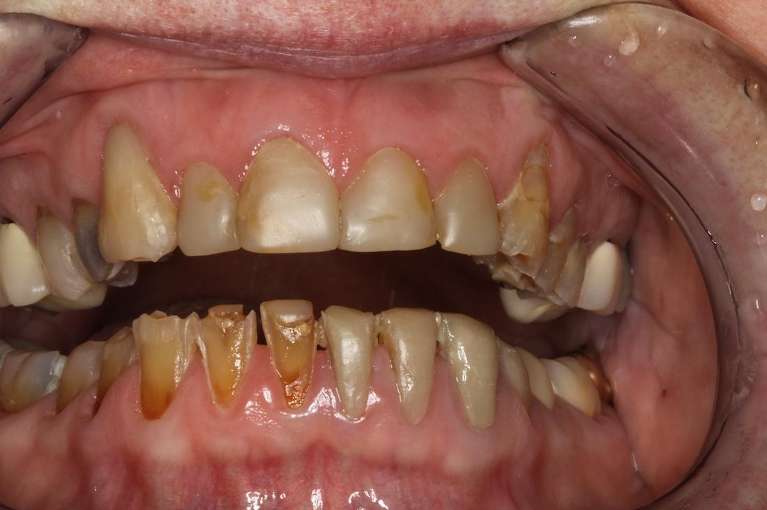 Composite-Dental-Fillings-Lower-Front-Teeth-Before-Image