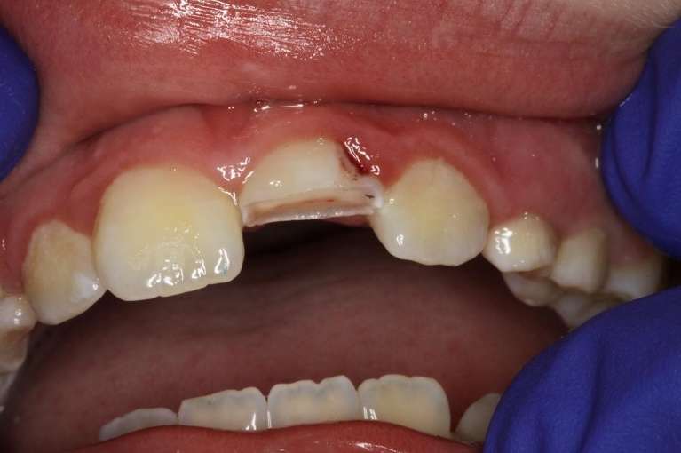 Front-Tooth-Dental-Trauma-Before-Image