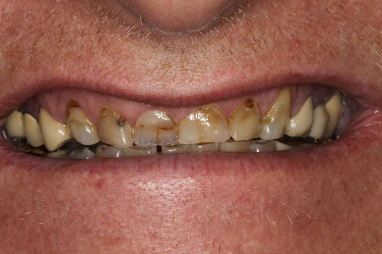 small and discolored teeth