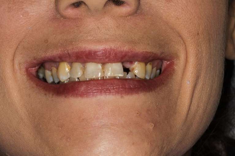 missing and worn front teeth