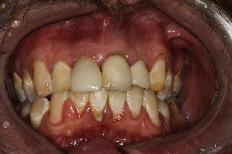 discolored teeth